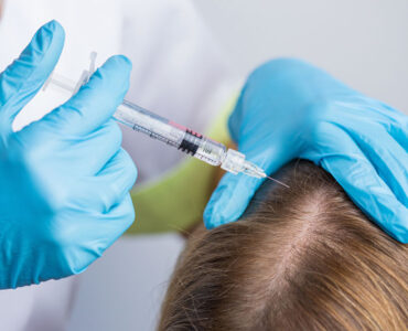 Intradermoterapia capilar